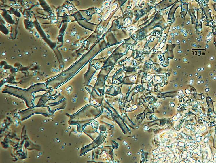 Crosta bianca su faggio - foto 5383 (Sistotrema sernanderi)
